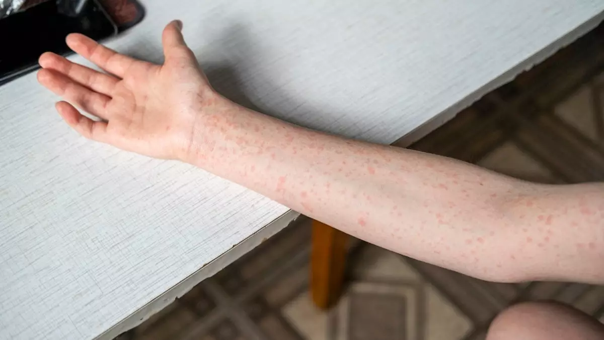 Крупнейшая за последнее время вспышка кори зарегистрирована в колледже на юго-западе.