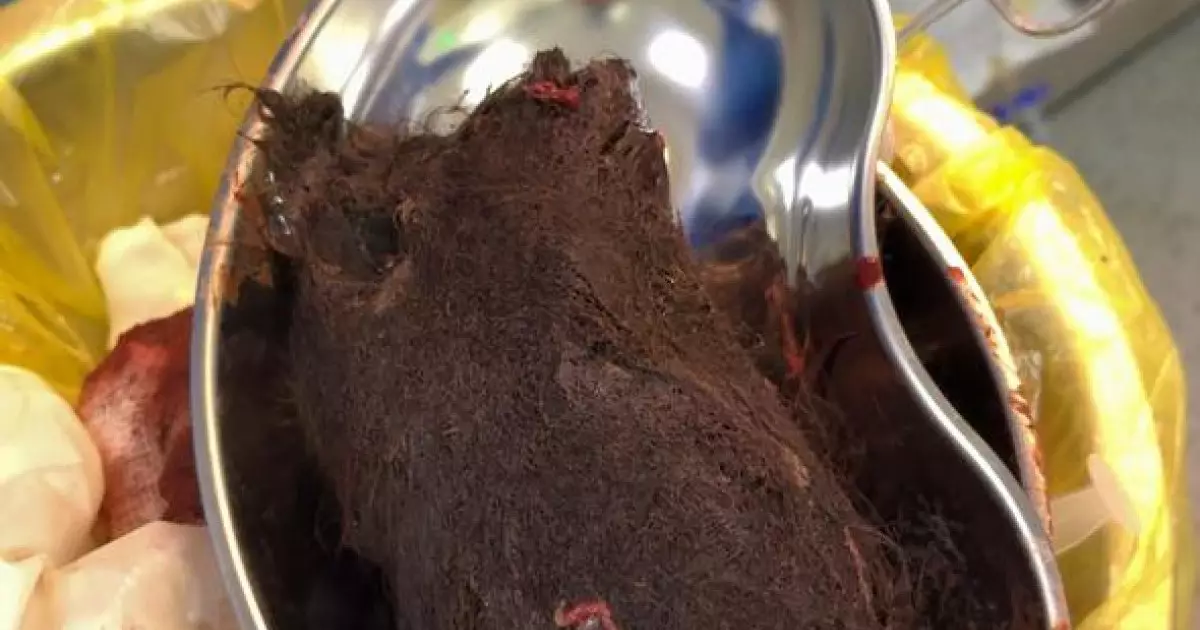  Түркістан облысында 15 жастағы қыздың асқазанынан 1 келі шаш шықты 