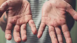 Қазақстандағы қызылша:  балалар неге ауырады және ата-аналар нені білуі керек?