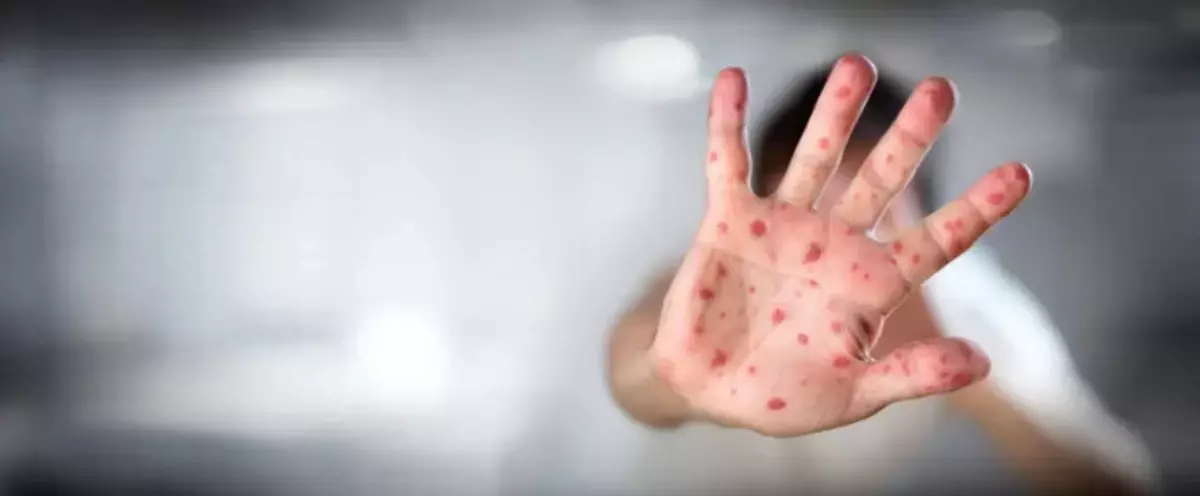 Алматыда бұрын екпе алған науқастардың бірі қызылшамен қайта ауырған