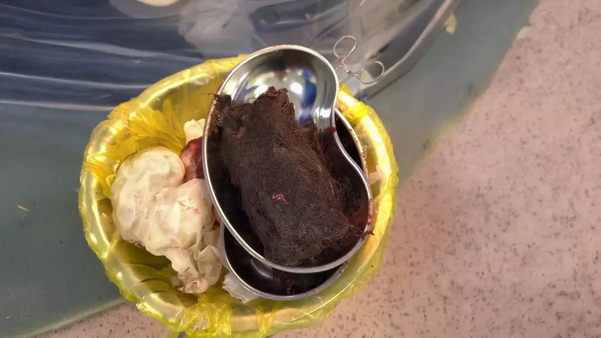 Түркістан облысында 15 жастағы қыздың асқазанынан 1 келі шаш шықты