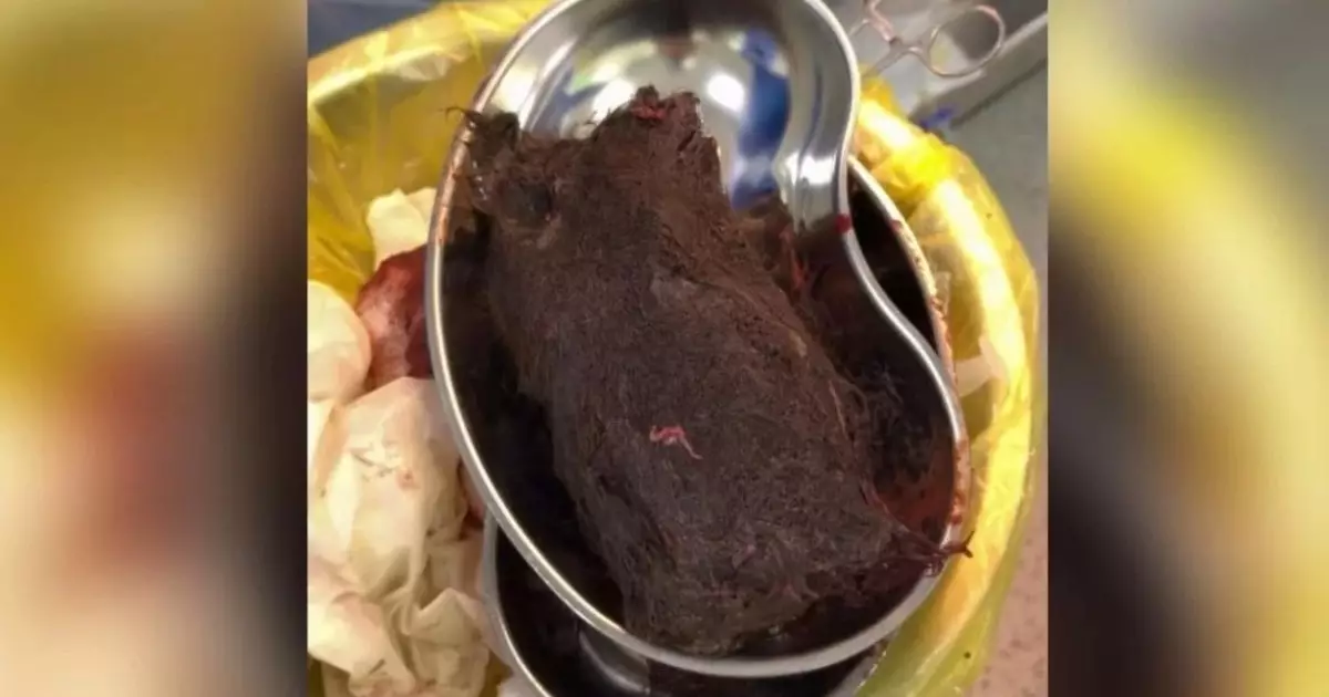  Түркістанда 15 жастағы қыздың асқазанынан 1 келідей шаш шықты 