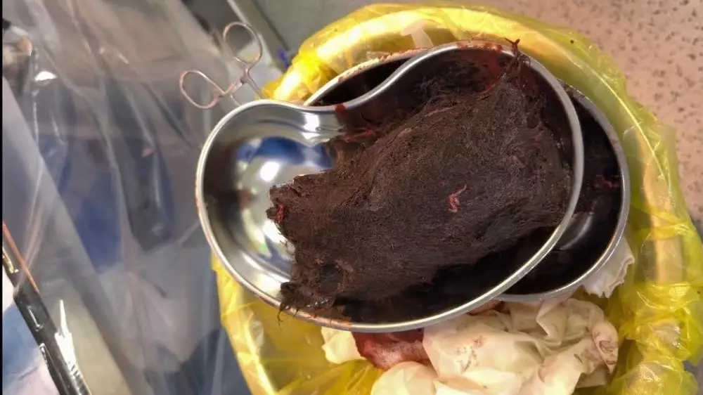 Почти килограмм волос нашли в желудке у девочки в Туркестанской области