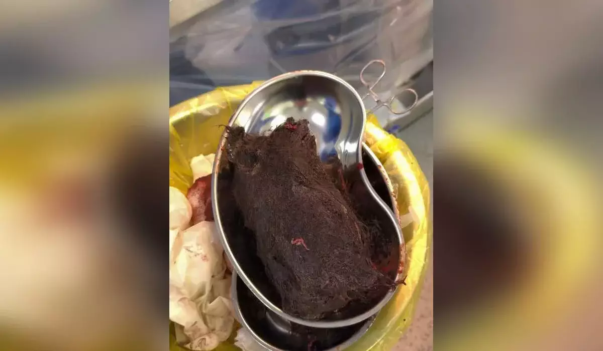 Түркістан дәрігерлері 15  жастағы қыздың асқазанынан 1 келі шаш алып шыққан