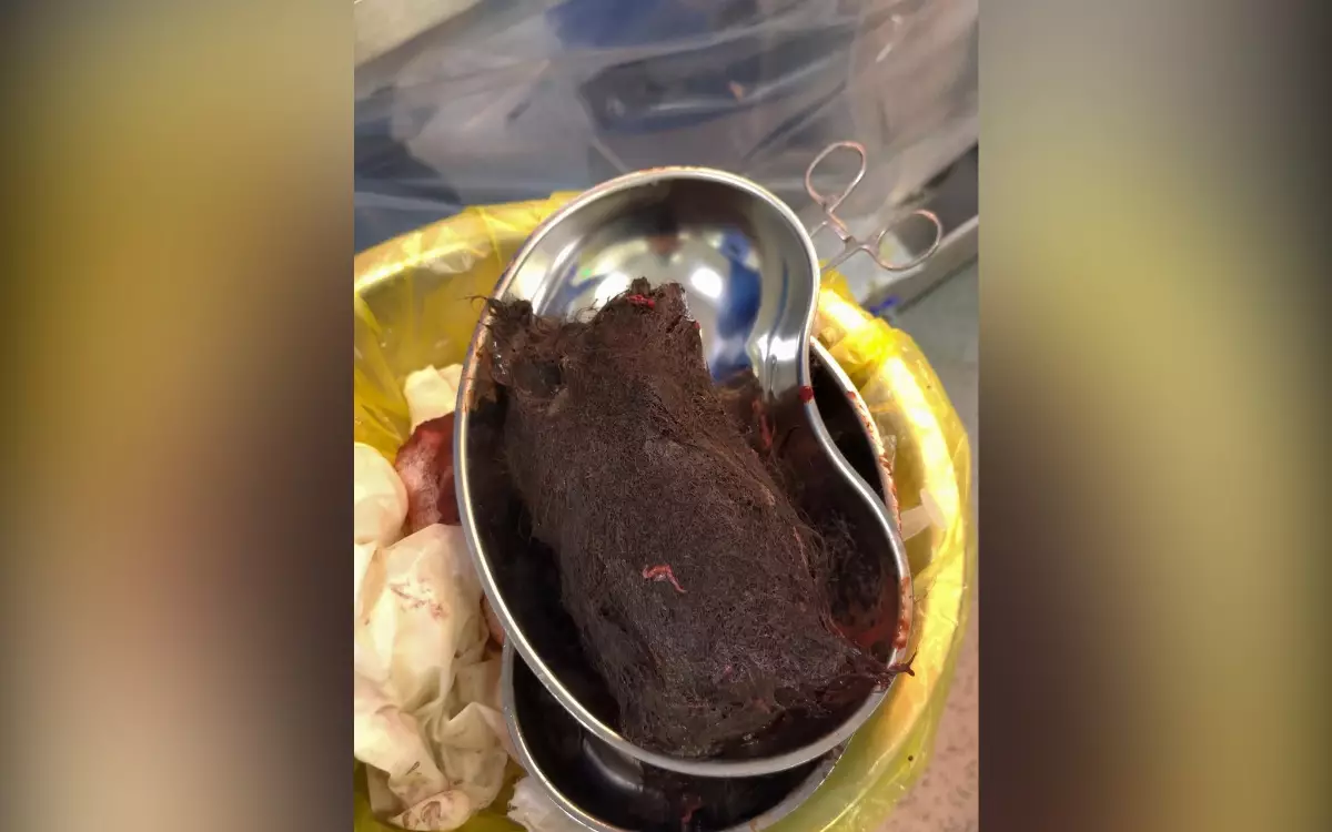 Безоар массой 900 грамм извлекли из желудка девушки из Туркестана