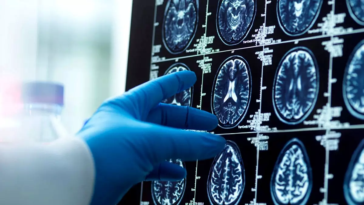 Обычные респираторные бактерии обнаружены в глазах пациентов с болезнью Альцгеймера.