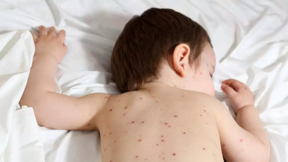 В Костанае детей с кишечной инфекцией перевели во взрослую больницу из-за  больных корью