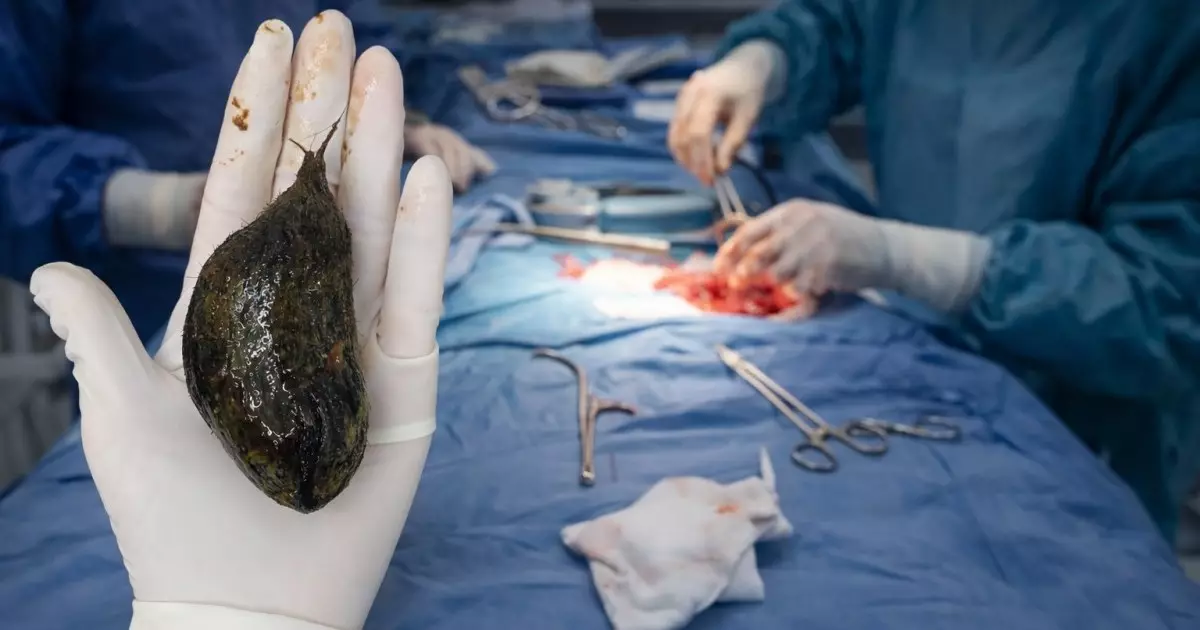  Түркістанда дәрігерлер жасөспірім қыздың асқазанынан 1 келіге жуық шаш түйінін алды 