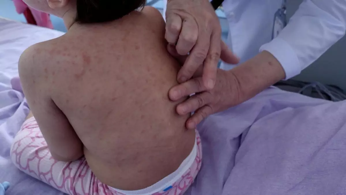 Корь не отступает: дети продолжают поступать в больницы Астаны