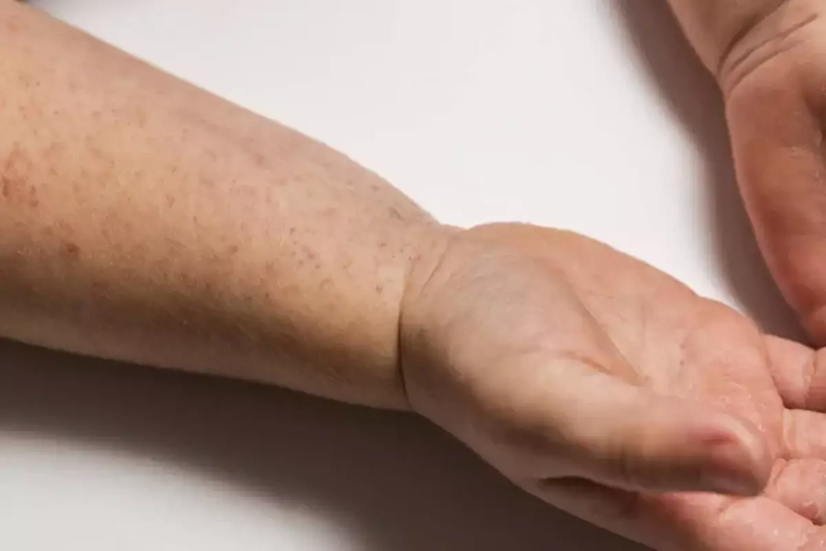 Қызылша өсімі байқалған 9 өңірде қосымша иммундау жұмысы күшейтілді