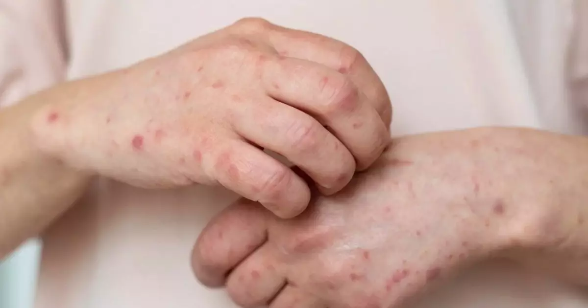  Қызылша құтырып барады. Ақтөбеде ауру жұқтырғандар үш есе көбейді 