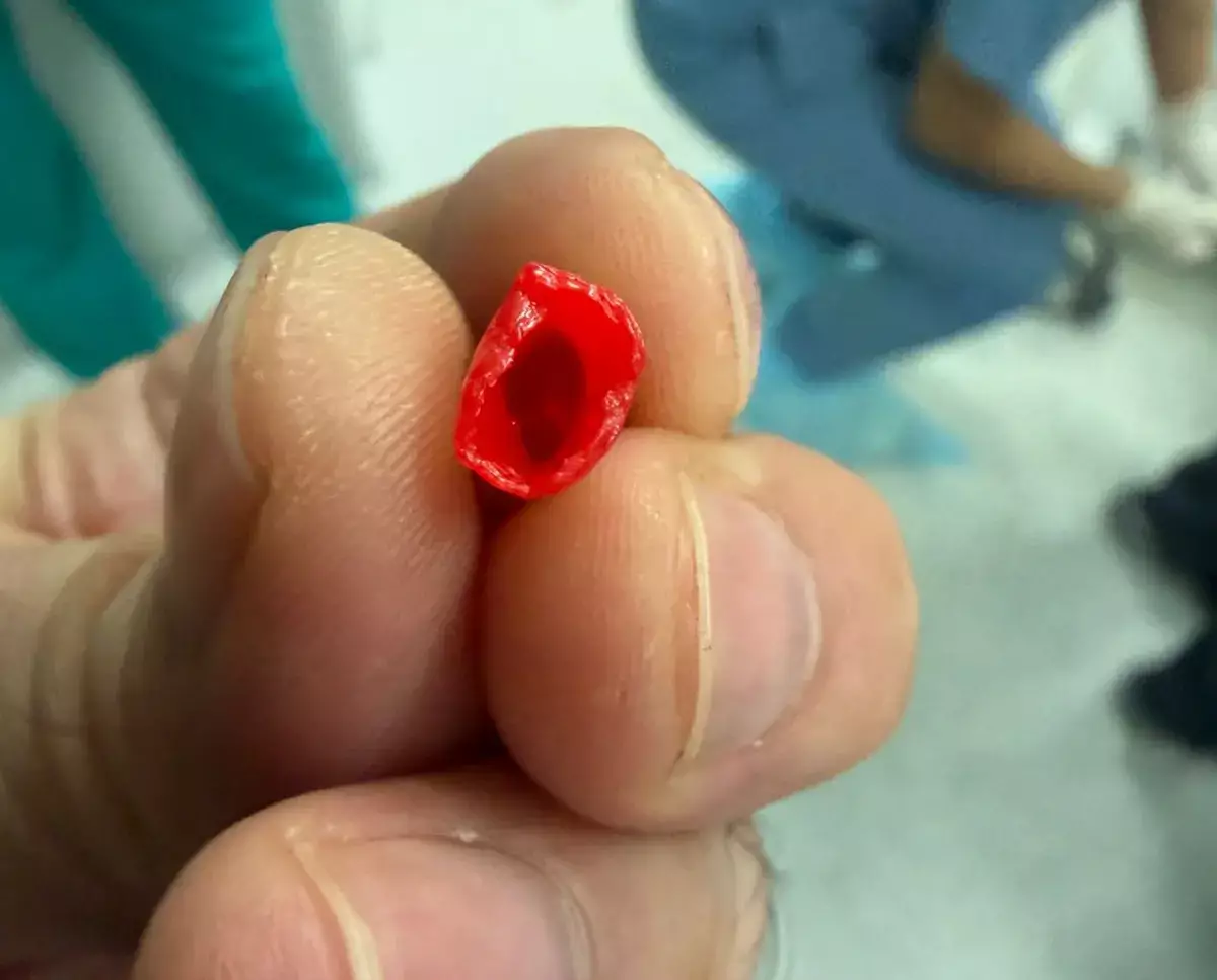 В Актау из бронхов ребенка извлекли колпачок от ручки - новости на Lada.kz 20.02.2026