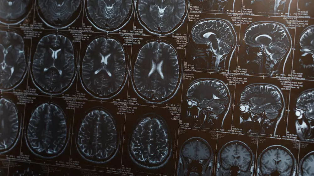 Названа простая привычка, снижающая риск деменции почти на 40 процентов