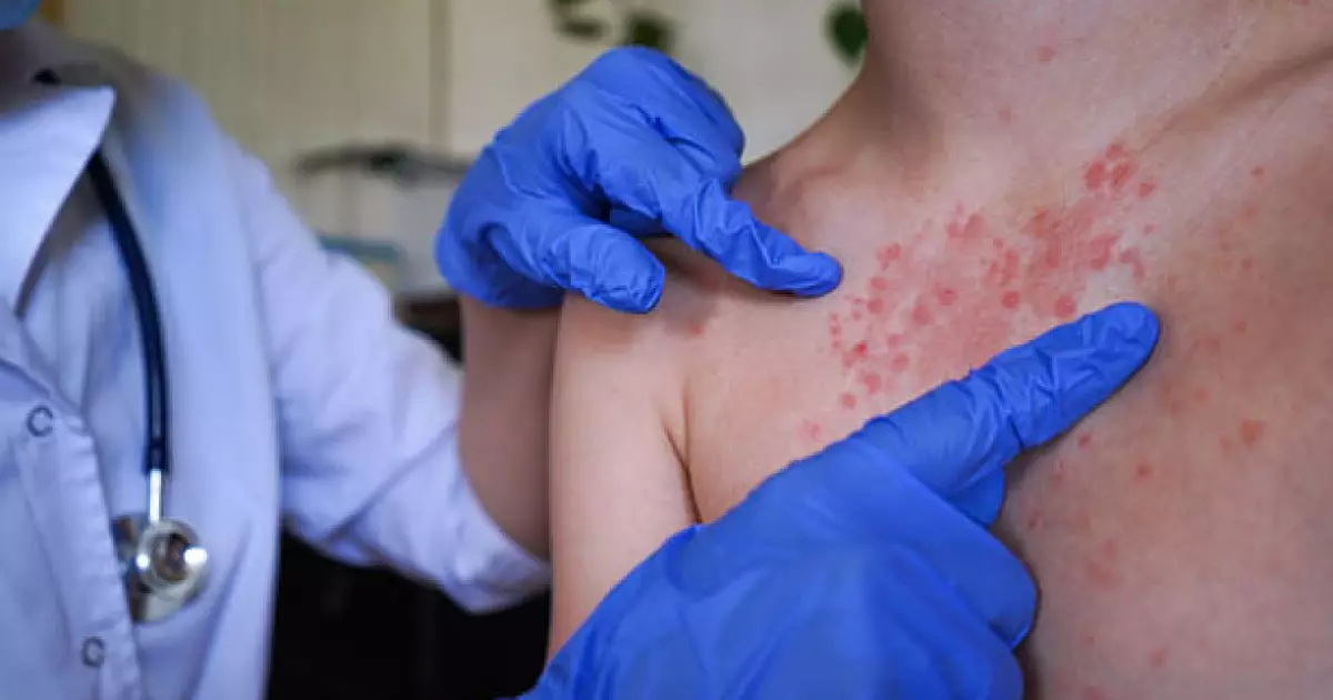   Қызылшаға қарсы екпе алмаған балалар мектепке де, балабақшаға да бармайды   