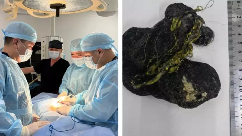 Асқазаннан шыққан шаш: Шымкентте 8 жасар балаға шұғыл ота жасалды