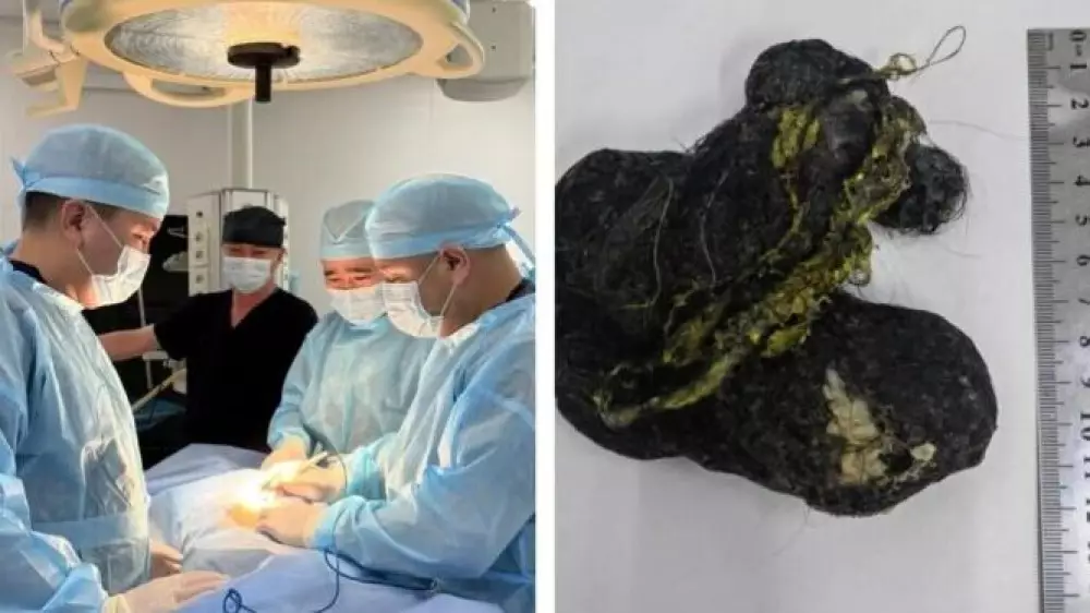 В Шымкенте из желудка ребенка извлекли 15-сантиметровый ком волос