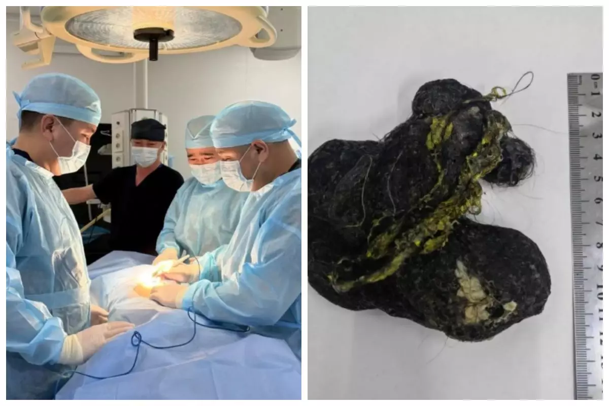 Шымкентте дәрігерлелар баланың асқазанынан бір уыс шаш алып шықты