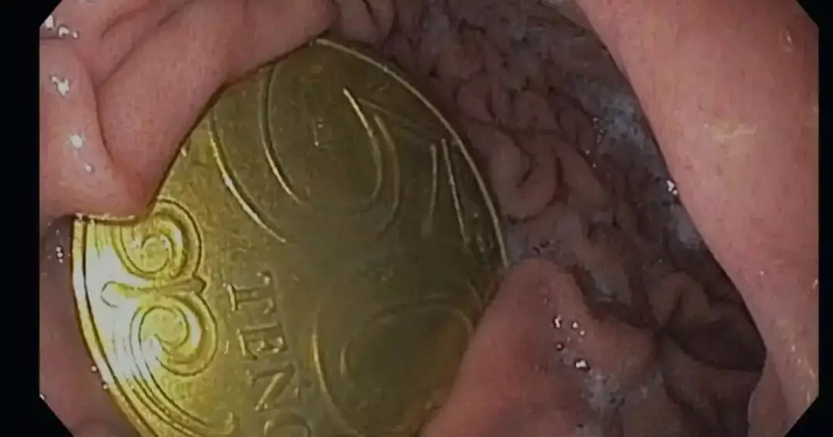  «Ата-анасы өзі түсіп қалады деп ойлаған»: Ақтауда бес жасар бала 50 теңгелік тиынды жұтып алып, үш күн жүрген (ФОТО) 