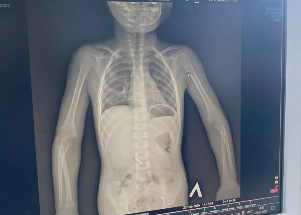 В Кокшетау трехлетняя девочка проглотила инструмент на приеме у стоматолога