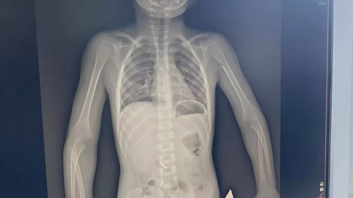 Көкшетауда стоматологияда 3 жасар қыз медициналық құралды жұтып қойды