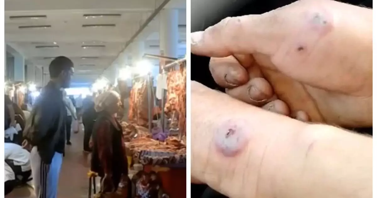  «Базардағы еттен тараған»: Шымкентте аса қауіпті жұқпалы ауру жұқтырған адам анықталды 