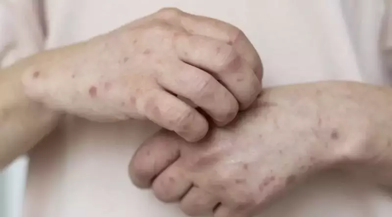 В Казахстане растёт заболеваемость корью: Минздрав усилил меры