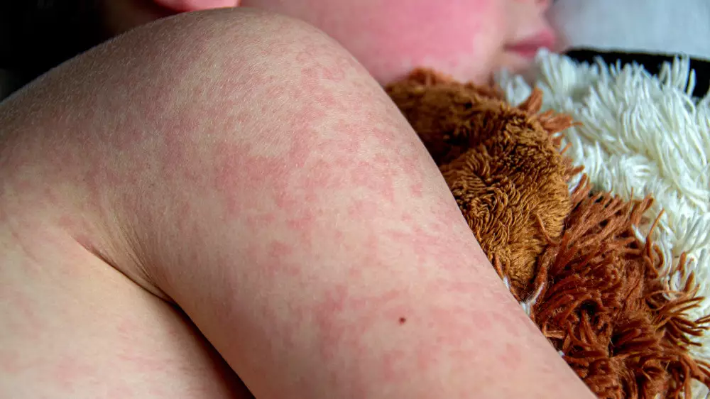 “Ситуация напряжённая“:  рост кори в Алматы и обращение главы Минздрава