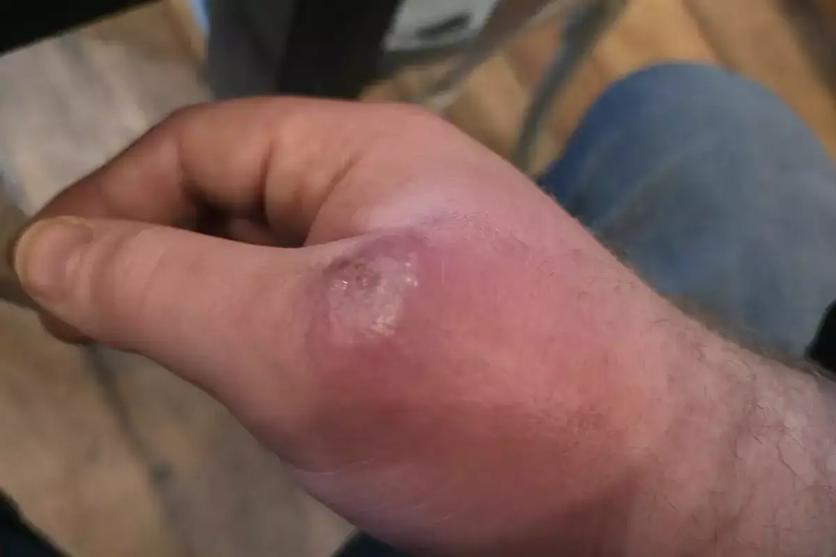 Рука мужчины превратилась в «боксерскую перчатку» после укуса паука - новости на Lada.kz 10.03.2026