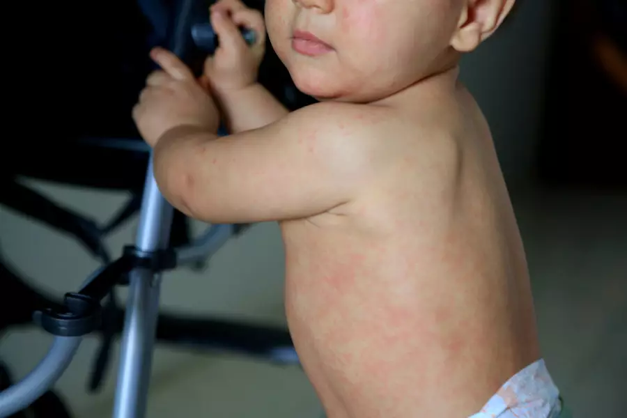 Ең жұқпалы ауру: маман қызылшаға байланысты ескерту жасады