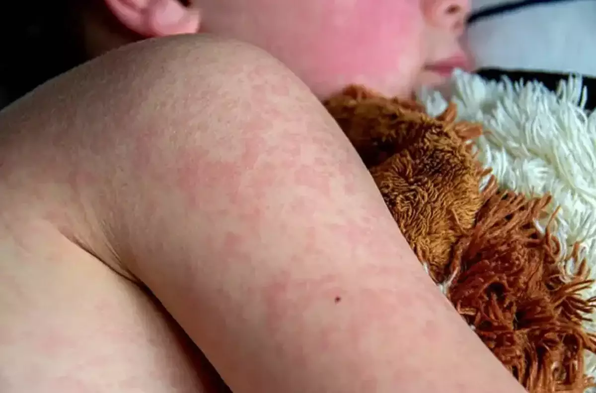 Қызылша: Павлодар облысында 67 адам жұқтырған