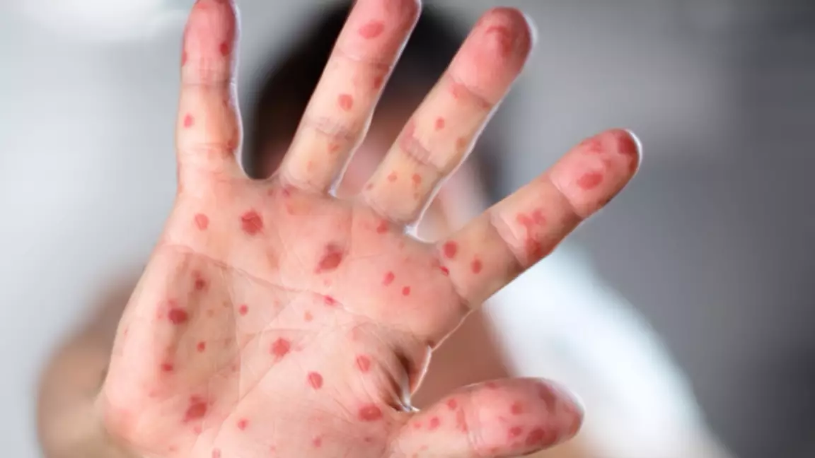 БҚО-да балаларды өлімге әкелуі мүмкін сирек дерт анықталды