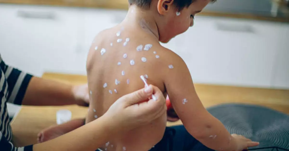  БҚО-да баладан қызылшаның өлімге әкелуі мүмкін қауіпті асқынуы анықталды 