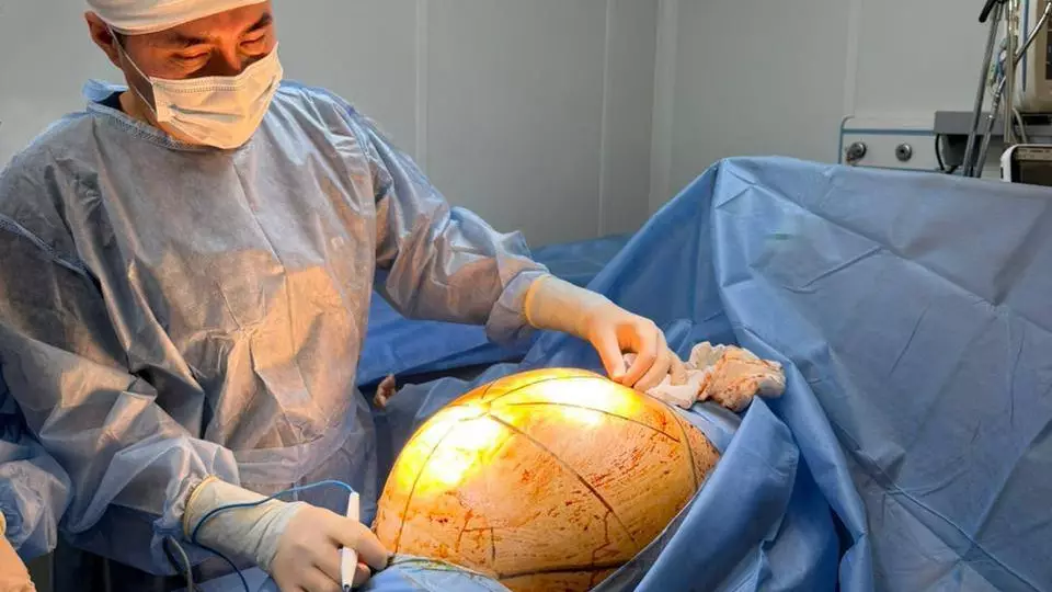 «Өзім емделемін» деген келіншектің ісігі 25 келіге жеткен: Дәрігерлер бірегей ота жасады