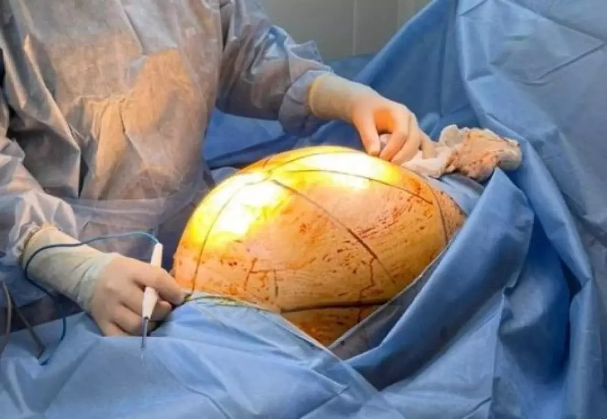 Казахстанка лечилась БАДами и довела опухоль до 25 кг