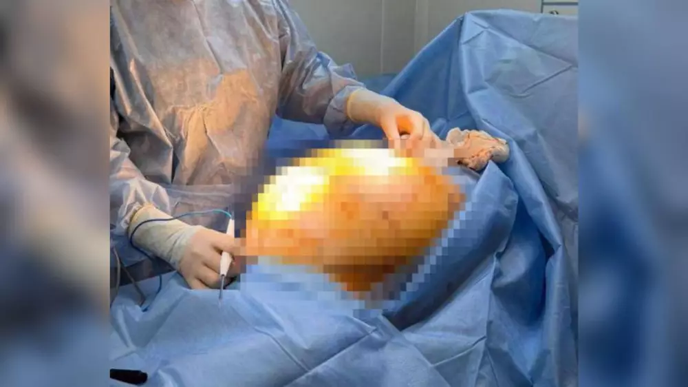 Лечила БАДами: 25-килограммовую опухоль удалили пенсионерке в Алматы