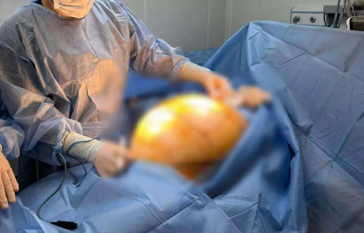 БАД ішіп емделмек болған: Алматылық әйелдің денесінен салмағы 25 келі болатын қатерлі ісік алынды