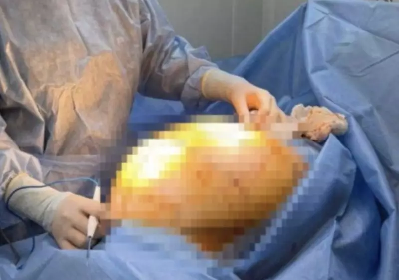 Пыталась вылечить БАДами: у алматинки удалили опухоль весом почти 25 кг