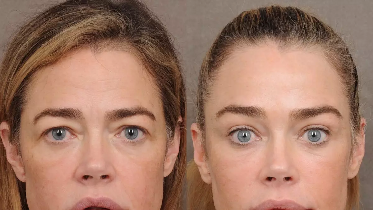 Дениз Ричардс представила «шокирующую» трансформацию после подтяжки лица в фотографиях «до и после».