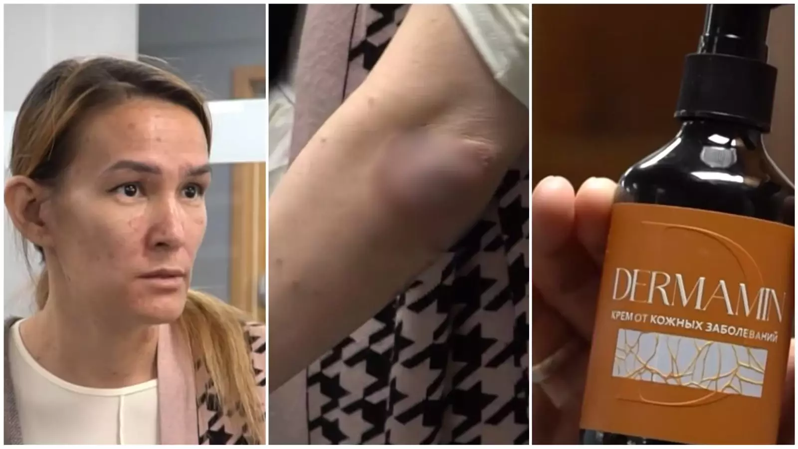 "Псориаздан айығып кетесіз деп сендірді": Жарнамаға алданған қазақстандық әйел жансақтаудан бір-ақ шықты