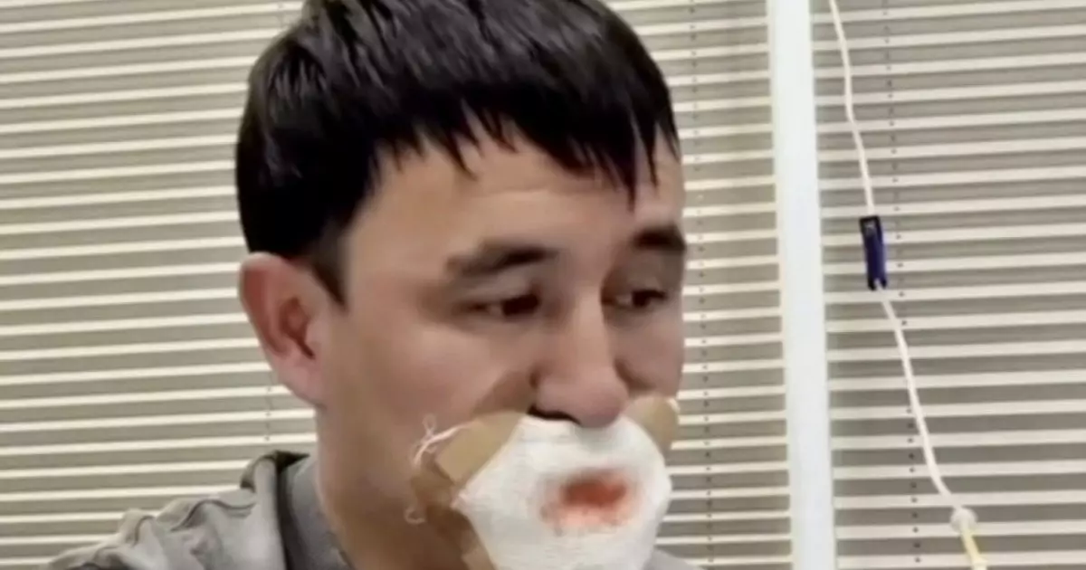  Романтика орнына трагедия: жігіт сүйісемін деп тілінен айрылып қалды 