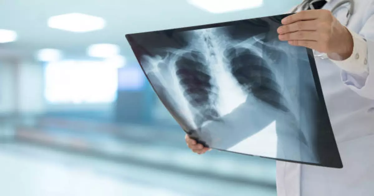   Туберкулезбен ауыратын науқастар саны азайды   