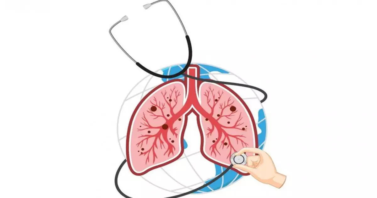   Өкпе дерті өрекпімесін   