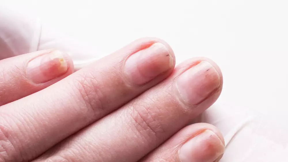 Врачи перечислили симптомы рака, которые видно сразу