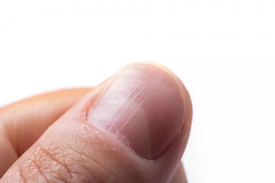 Тырнаққа мән беріңіз: дәрігерлер бірден байқалатын қатерлі ісік белгілерін атады