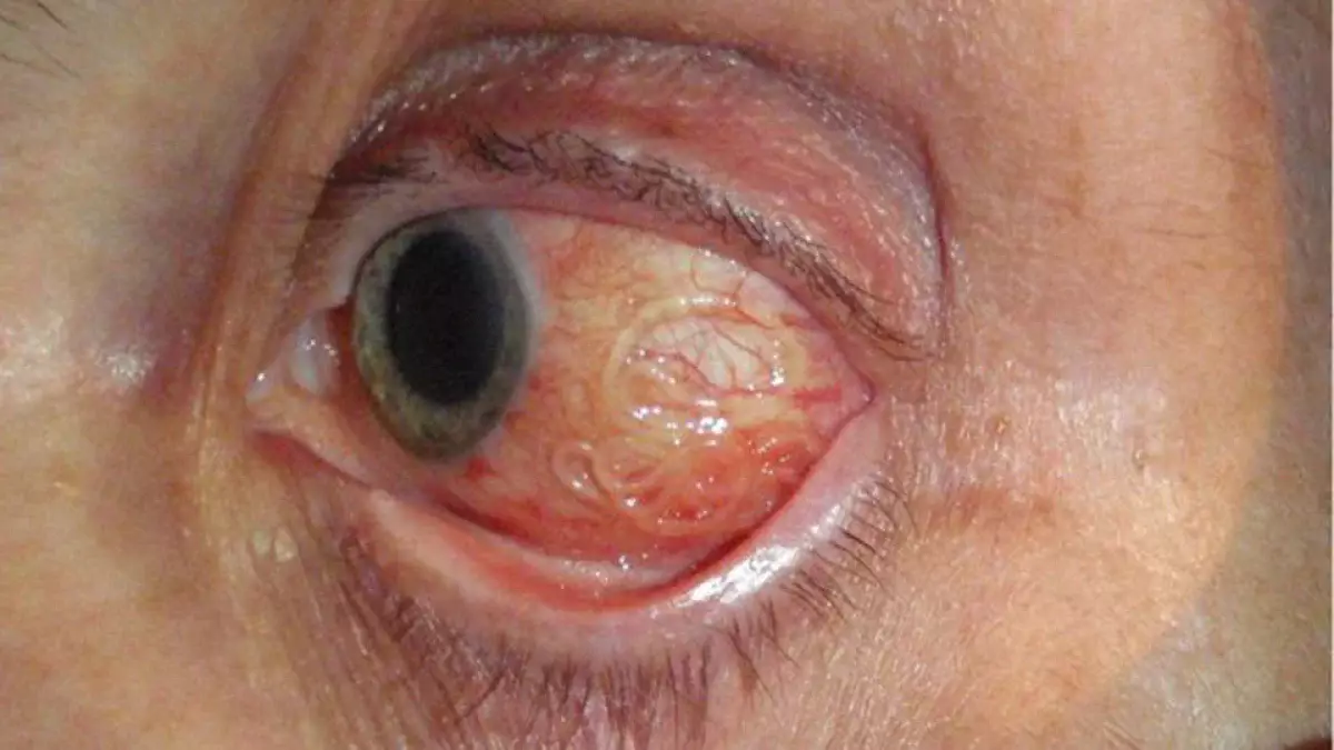 Живого червя достали из глаза мужчины после укуса комара
