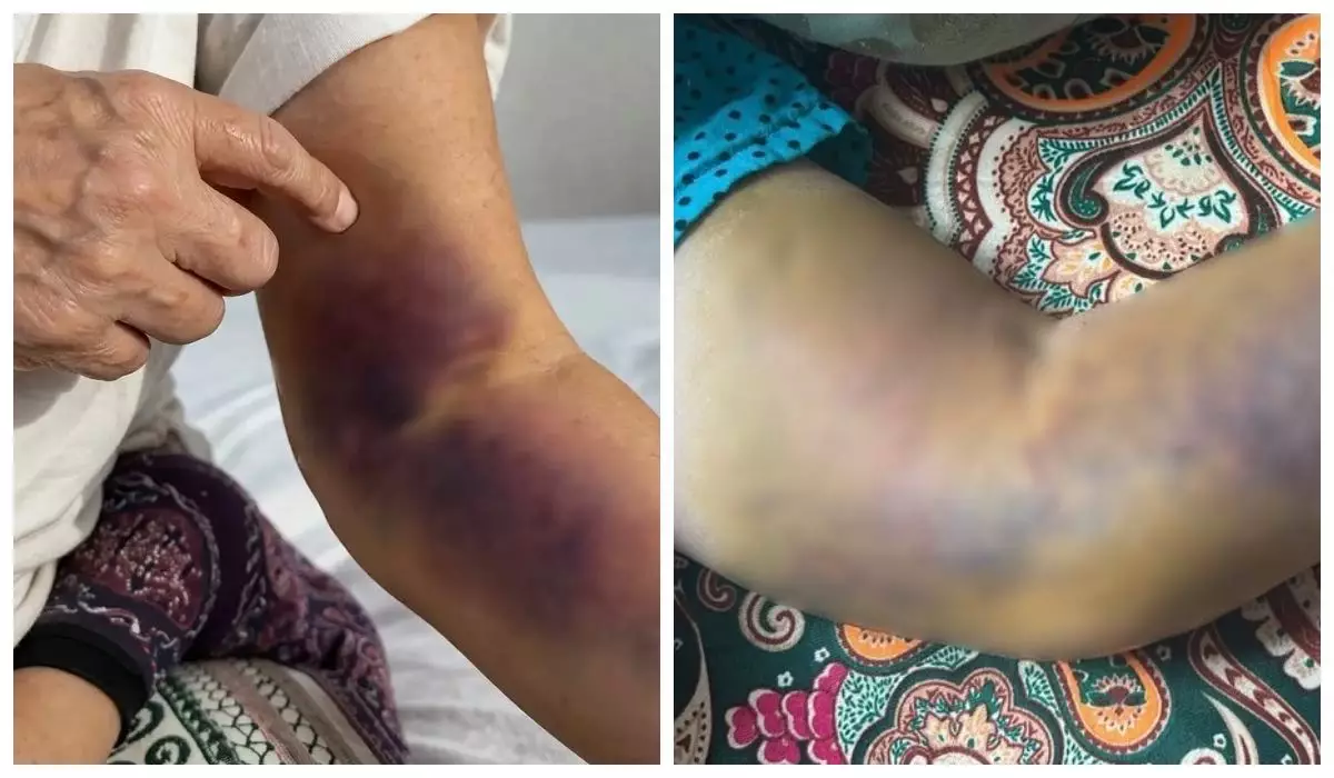 Қазақстандық әйелдің тамырына салынған екпеден кейін қолы жұмыс істемей қалған