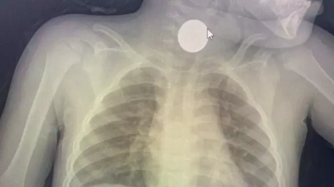 Жамбыл облысында дәрігер 3 жасар баланың өңешінен 100 теңгені алып шықты