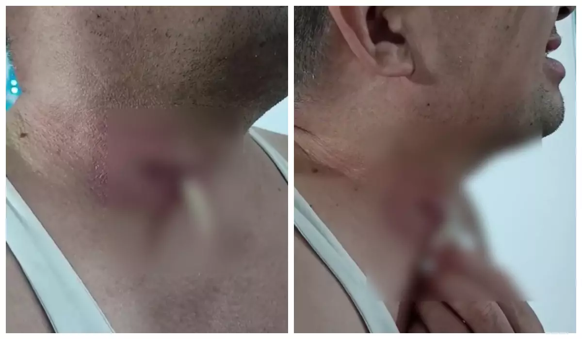 Ақтөбе тұрғыны дәрігерлер ұмытып кеткен дәкені тамағынан өз бетінше суырып шығарған (видео)