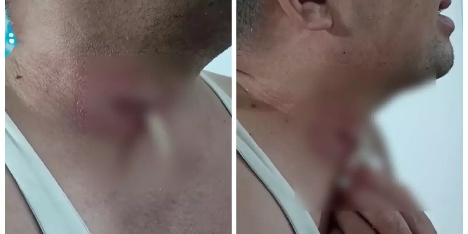 Ота жасатқан ақтөбелік ер адамның тамағында дәке қалып қойған (ВИДЕО)