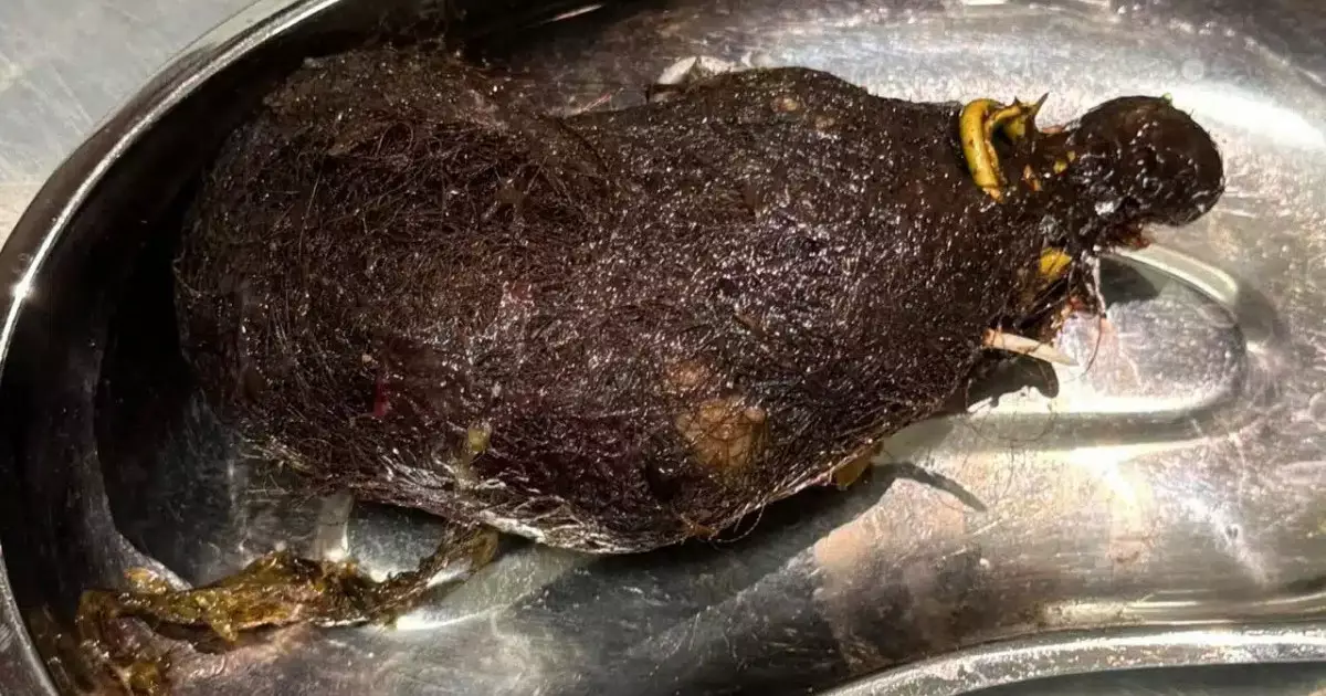  Алматыда шашын жей беретін 12 жастағы қыздың асқазанына ота жасалды 